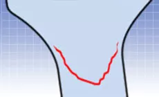 Fissure en forme de sourire